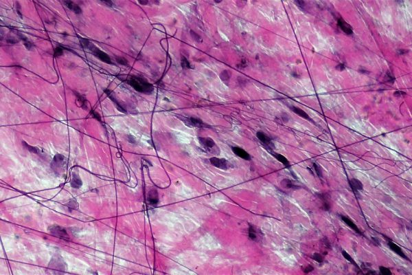 Fascia’s Relationship to Chronic Pain and Joint Degeneration