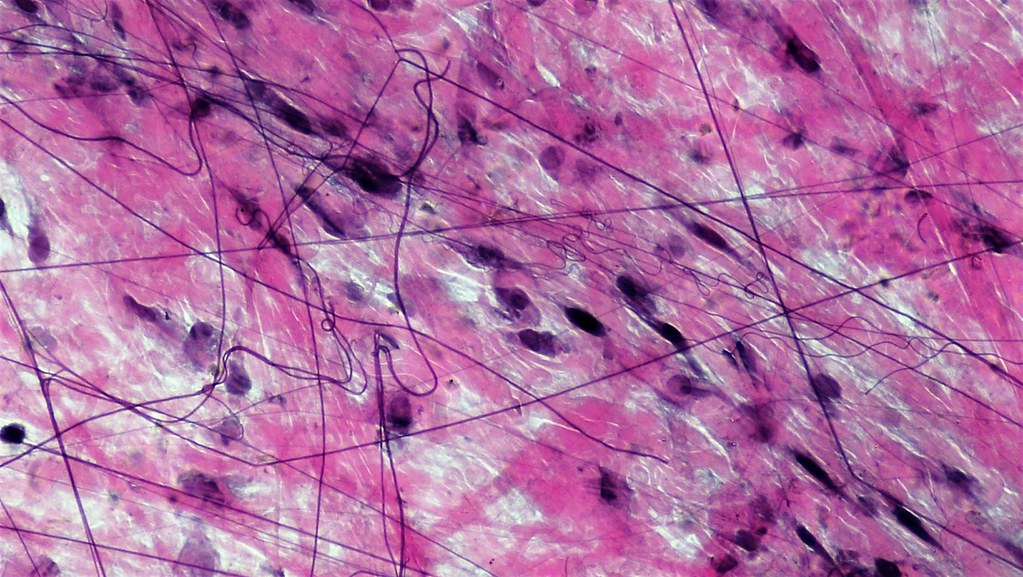 Fascia’s Relationship to Chronic Pain and Joint Degeneration